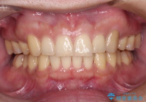 気になる八重歯を抜歯矯正で改善　補助装置を用いたインビザライン矯正の症例 治療後