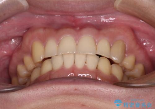 気になる八重歯を抜歯矯正で改善 補助装置を用いたインビザライン矯正の治療後