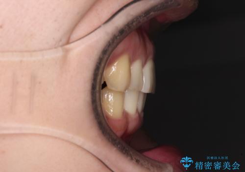 気になる八重歯を抜歯矯正で改善 補助装置を用いたインビザライン矯正の治療後