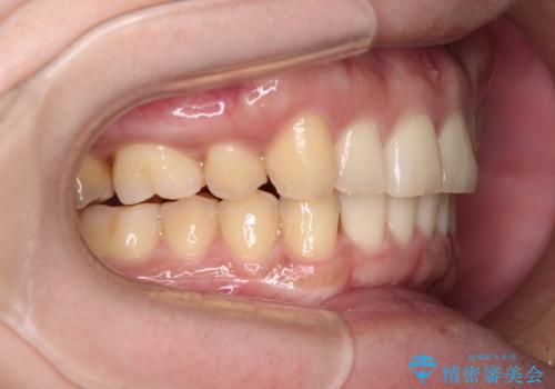 気になる八重歯を抜歯矯正で改善　補助装置を用いたインビザライン矯正の治療後
