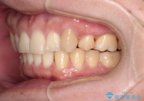 気になる八重歯を抜歯矯正で改善　補助装置を用いたインビザライン矯正の治療後