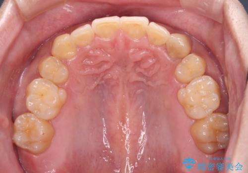 気になる八重歯を抜歯矯正で改善 補助装置を用いたインビザライン矯正の治療後