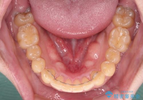 気になる八重歯を抜歯矯正で改善 補助装置を用いたインビザライン矯正の治療後