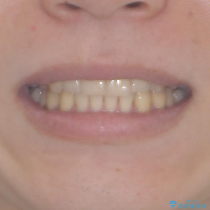 気になる八重歯を抜歯矯正で改善　補助装置を用いたインビザライン矯正の治療後（顔貌）