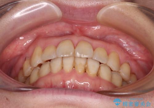 前歯のクロスバイトを治したい　インビザラインによる矯正治療の治療後