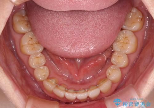 前歯のクロスバイトを治したい　インビザラインによる矯正治療の治療後