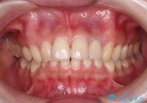 むし歯で変色した前歯をセラミッククラウンできれいにの治療後