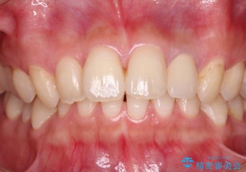 むし歯で変色した前歯をセラミッククラウンできれいに