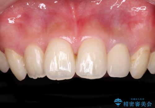 むし歯で変色した前歯をセラミッククラウンできれいにの症例 治療後