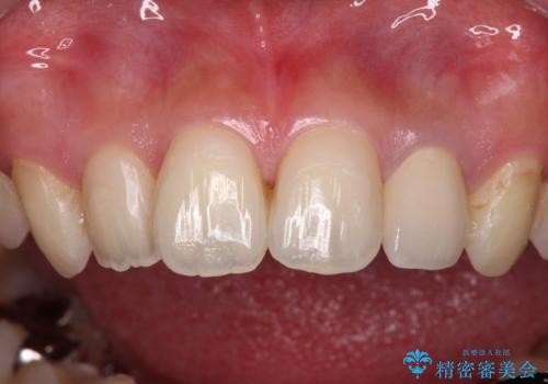 むし歯で変色した前歯をセラミッククラウンできれいにの治療後