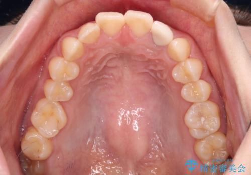 むし歯で変色した前歯をセラミッククラウンできれいにの治療後