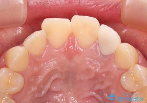 むし歯で変色した前歯をセラミッククラウンできれいにの治療後