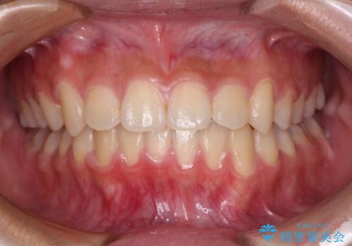 急速拡大装置で狭い歯列を骨格ごと改善 ワイヤー装置による矯正治療の治療後