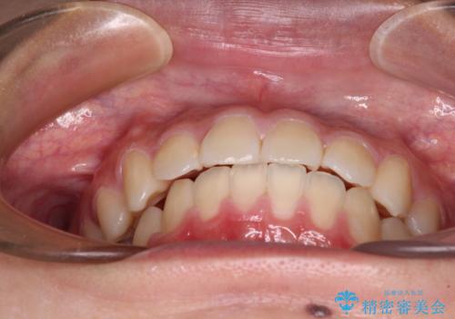 急速拡大装置で狭い歯列を骨格ごと改善 ワイヤー装置による矯正治療の治療後