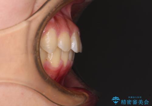 急速拡大装置で狭い歯列を骨格ごと改善 ワイヤー装置による矯正治療の治療後