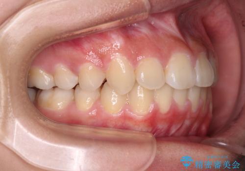 急速拡大装置で狭い歯列を骨格ごと改善 ワイヤー装置による矯正治療の治療後