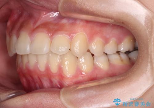 急速拡大装置で狭い歯列を骨格ごと改善 ワイヤー装置による矯正治療の治療後