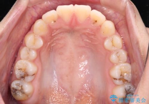 急速拡大装置で狭い歯列を骨格ごと改善 ワイヤー装置による矯正治療の治療後