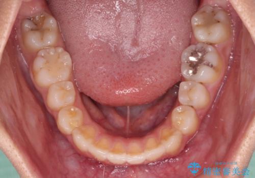 急速拡大装置で狭い歯列を骨格ごと改善 ワイヤー装置による矯正治療の治療後