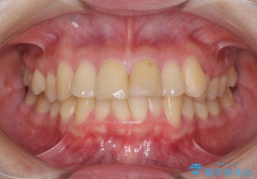 上下前歯のデコボコをきれいに　インビザラインによる矯正治療の症例 治療前