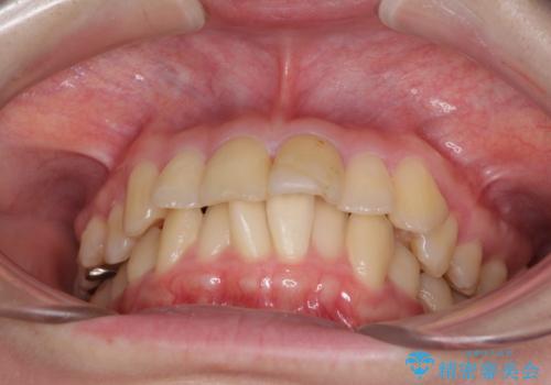 上下前歯のデコボコをきれいに インビザラインによる矯正治療の治療前