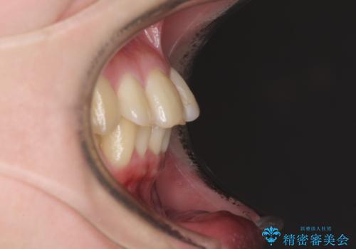 上下前歯のデコボコをきれいに インビザラインによる矯正治療の治療前