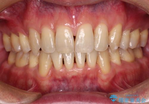 掃除しにくい前歯と閉じにくい口元　目立たないワイヤー装置での抜歯矯正