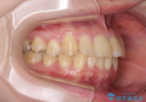 上下前歯のデコボコをきれいに　インビザラインによる矯正治療の治療前