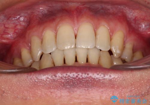 掃除しにくい前歯と閉じにくい口元 目立たないワイヤー装置での抜歯矯正の治療後