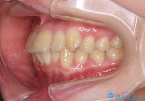 上下前歯のデコボコをきれいに インビザラインによる矯正治療の治療前