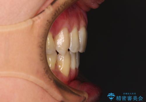 掃除しにくい前歯と閉じにくい口元 目立たないワイヤー装置での抜歯矯正の治療後