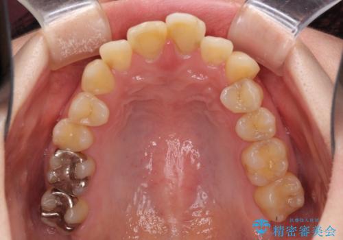 上下前歯のデコボコをきれいに インビザラインによる矯正治療の治療前