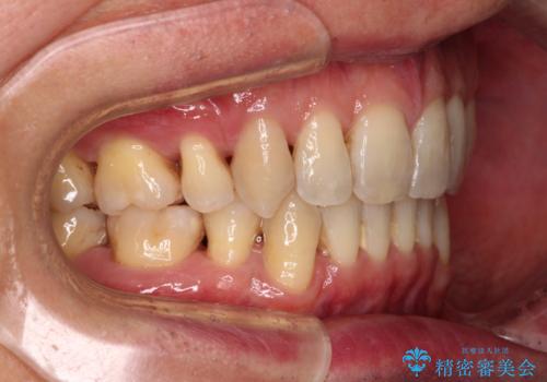 掃除しにくい前歯と閉じにくい口元 目立たないワイヤー装置での抜歯矯正の治療後
