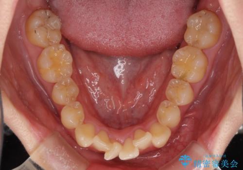上下前歯のデコボコをきれいに インビザラインによる矯正治療の治療前