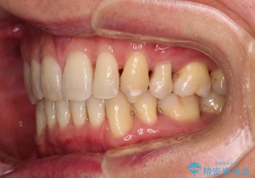 掃除しにくい前歯と閉じにくい口元 目立たないワイヤー装置での抜歯矯正の治療後