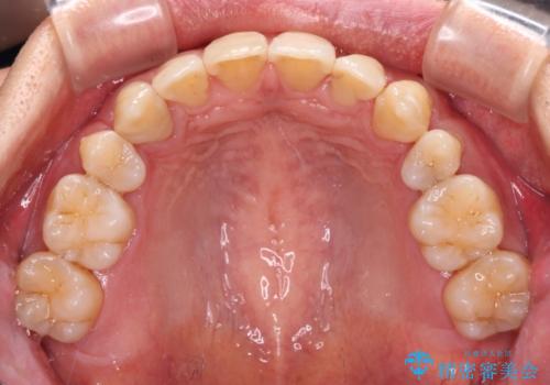 掃除しにくい前歯と閉じにくい口元 目立たないワイヤー装置での抜歯矯正の治療後