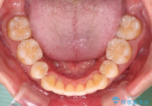 掃除しにくい前歯と閉じにくい口元 目立たないワイヤー装置での抜歯矯正の治療後