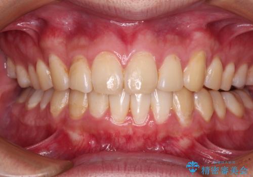 気になる前歯を治したい　短期間でのインビザライン矯正の症例 治療後