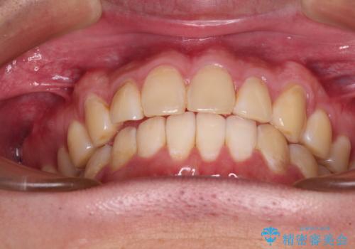 気になる前歯を治したい 短期間でのインビザライン矯正の治療後