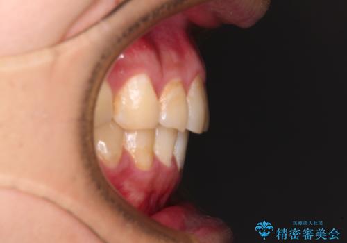 気になる前歯を治したい 短期間でのインビザライン矯正の治療後