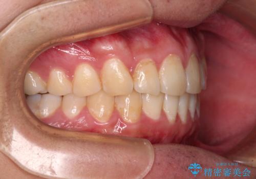 気になる前歯を治したい　短期間でのインビザライン矯正の治療後