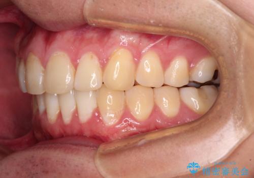 気になる前歯を治したい 短期間でのインビザライン矯正の治療後