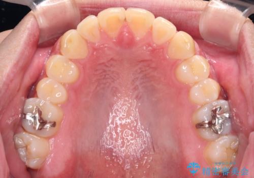 気になる前歯を治したい 短期間でのインビザライン矯正の治療後