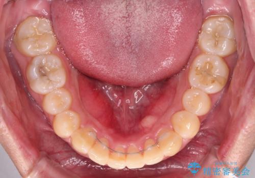 気になる前歯を治したい 短期間でのインビザライン矯正の治療後