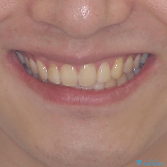 気になる前歯を治したい 短期間でのインビザライン矯正の治療後(顔貌)