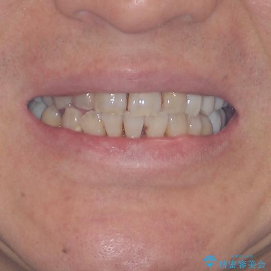 歯並びや奥歯の痛み 色々と治したい 総合歯科診療の治療後(顔貌)