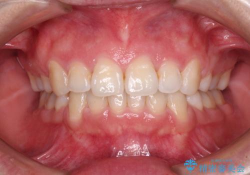 ふっくらとした口元を改善したい　目立たないワイヤー装置による抜歯矯正の治療後