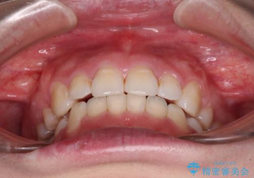 ふっくらとした口元を改善したい 目立たないワイヤー装置による抜歯矯正の治療後