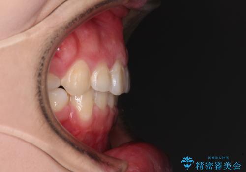 ふっくらとした口元を改善したい 目立たないワイヤー装置による抜歯矯正の治療後