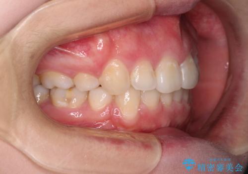 ふっくらとした口元を改善したい 目立たないワイヤー装置による抜歯矯正の治療後